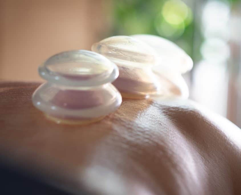 Cupping bij rugklachten Utrecht